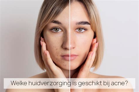 acneverzorging